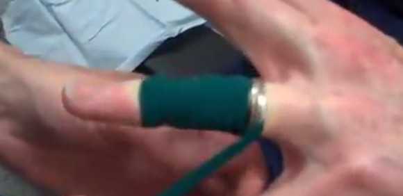 Как снять кольцо с опухшего пальца – 10 способов